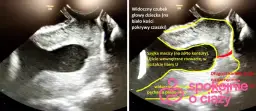 Skrócona szyjka macicy a poród: Kiedy spodziewać się rozwiązania?
