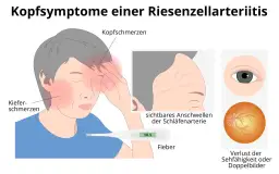 Morbus Horton Diagnostik: Wichtige Kriterien und Symptome erkennen