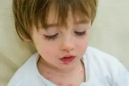 Ile trwa ospa wietrzna u dziecka? Zaskakujące fakty o chorobie