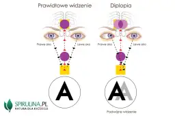 Podwójne widzenie przyczyny neurologiczne: co może je powodować?