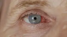 Jak szybko rozwija się zaćma i co przyspiesza jej rozwój?