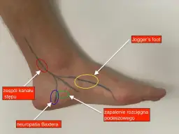 Ból pięty u biegacza jak go pokonać i biegać bez kontuzji?