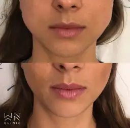 Botoks na bruksizm: Kiedy efekty? Od ulgi po zmianę rysów twarzy