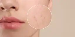 Podskórny pryszcz: Przyspiesz dojrzewanie i uniknij blizn!