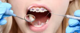 Czym się różni dentysta od ortodonty i kiedy ich potrzebujesz?