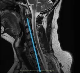 Skręcenie karku: Jak rozpoznać uraz i kiedy na SOR?