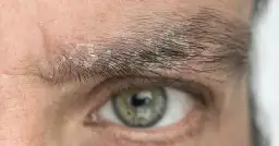 Pryszcz między brwiami: Szybkie sposoby na pozbycie się i zapobieganie