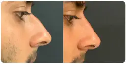 Rinomodelación con ácido hialurónico: mejora tu nariz sin cirugía