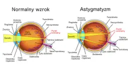 Skąd się bierze astygmatyzm? Poznaj przyczyny i objawy tej wady wzroku