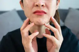 Rana po pryszczu? Zagój ją szybko domowymi metodami i uniknij blizn