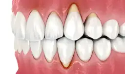 Skuteczne sposoby na spuchnięte dziąsła, które przynoszą ulgę