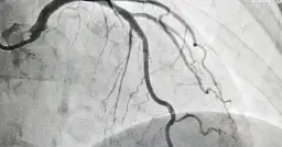 Obraz koronarografii przedstawiający naczynia wieńcowe. Może być pomocny przy ubieganiu się o odszkodowanie za koronarografię.