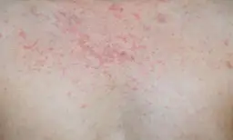 Rumień nagły u dorosłych objawy - jak je rozpoznać i leczyć