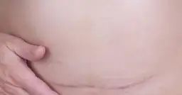 Jakie zioła na zrosty pooperacyjne są najskuteczniejsze?