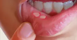 Afta a dentysta: Przełożyć wizytę czy iść? Jasne wskazówki.