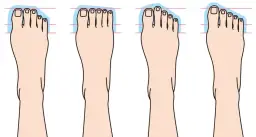Co zrobić z haluksami? Skuteczne metody na ulgę i leczenie