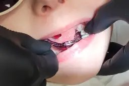 Czy aparat ortodontyczny boli? Sprawdzone sposoby na dyskomfort