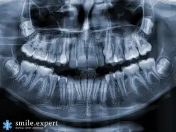 Czy RTG zębów jest bezpieczne? Prawda o dawkach i częstotliwości