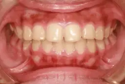 Czy zapalenie dziąseł jest zakaźne? Rozwiewamy mity i obawy!