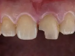 Tymczasowy ząb w domu: Szybkie maskowanie czy ryzyko? Poradnik