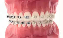 Ile zakłada się aparat na zęby? Poznaj czas i przebieg wizyty