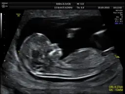 Płeć dziecka: Kiedy i jak ją poznać? NIPT (10 tyg.), USG poradnik