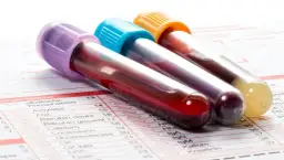 Podwyższony poziom androstendionu: objawy, przyczyny i skutki zdrowotne