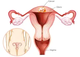 Síntomas de cáncer de útero que no debes ignorar para tu salud