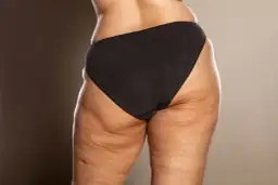 Cellulit na udach: Twój kompleksowy przewodnik do gładkiej skóry