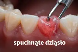 Zapalenie dziąseł: objawy, leczenie i kiedy pilnie do dentysty?