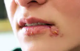 Opryszczka a dentysta: Czy wizyta jest możliwa i bezpieczna?