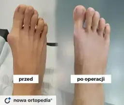 Operacja haluksa: Na czym polega? Pełny przewodnik dla pacjenta