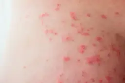 Pryszcze na pośladkach? Poznaj przyczyny i skuteczne rozwiązania