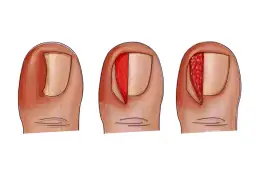 Jak pozbyć się wrastającego paznokcia - skuteczne metody i porady