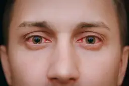 Zaczerwienione oczy przyczyna: poznaj najczęstsze powody i objawy