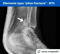 Złamana kostka boczna: Ile trwa leczenie i powrót do sprawności?