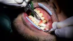 Ile trwa wyrywanie zęba 5? Czas zabiegu, który może zaskoczyć