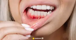 Zapalenie dziąseł: Objawy, przyczyny i kiedy iść do dentysty