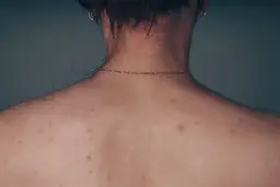 Jak skutecznie pozbyć się pryszczy na plecach i odzyskać pewność siebie