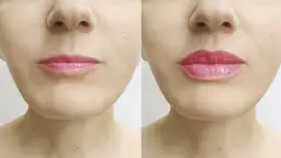 Powiększanie ust: Ile trwa cała wizyta w gabinecie?