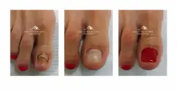 Uszkodzony paznokieć: Jak skutecznie go zregenerować i odbudować?