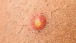 Pryszcze na pośladkach: Przyczyny i skuteczne sposoby na gładką skórę