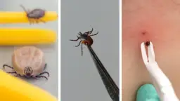 Jak usunąć kleszcza? Uniknij błędów i chroń zdrowie!
