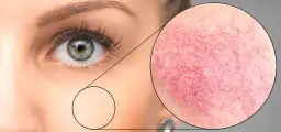 Rumień i pajączki? Jak skutecznie pozbyć się cery naczynkowej