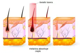 Depilacja laserowa: Jak działa? Laser czy IPL? Wybierz mądrze!