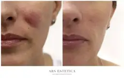 Opuchlizna po kwasie hialuronowym? Szybka ulga i sprawdzone triki