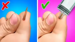 Jak lekarz wyjmuje drzazgę spod paznokcia - poznaj bezpieczną metodę usunięcia