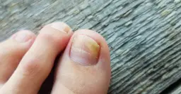 Zbliżenie na palec u nogi z żółtym, zniszczonym paznokciem.