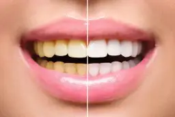 Wybielanie zębów u dentysty: metody, koszty i trwałość efektów