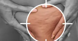 Jak wygląda cellulit wodny? Objawy, cechy i różnice z tłuszczowym